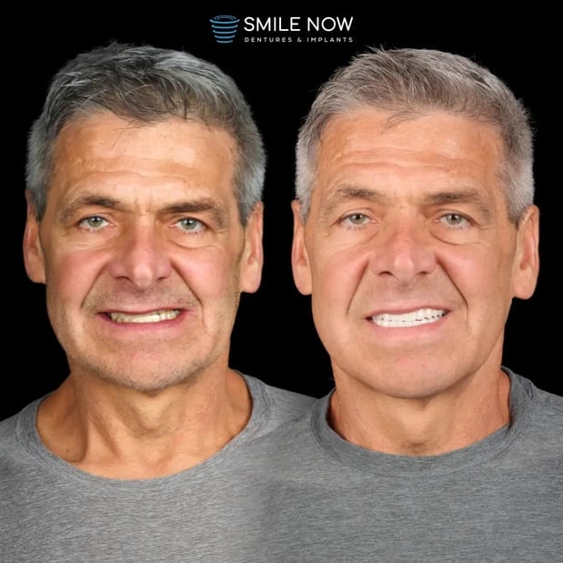 Images Smile Now Milwaukee Dentures and Implants