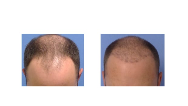 Images Hair Restoration Institute of the Hudson Valley