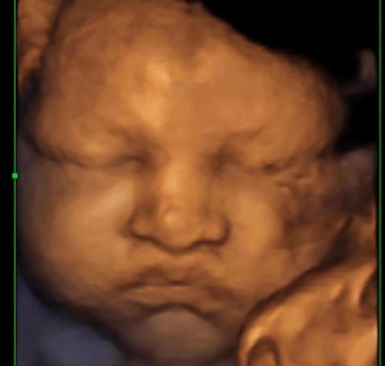 Image 9 | Belly 2 Birth 3D 4D Ultrasound