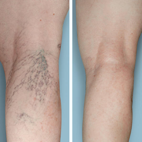 Before and after: spider vein removal results. We offer a variety of FDA-approved spider vein treatments, including vein laser!