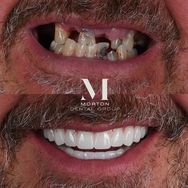 Images Nashville Wisdom Teeth and Implant Solutions