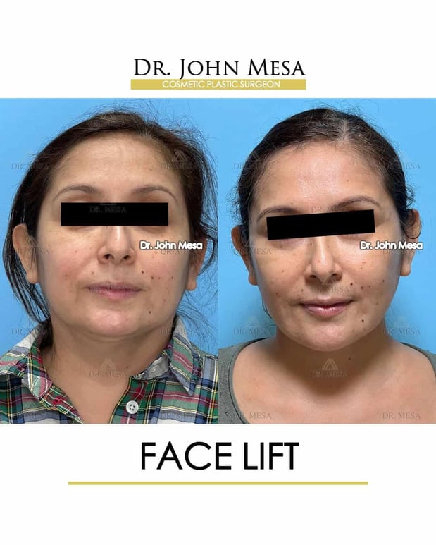 Images Dr. John Mesa, MD: Plastic Surgeon NYC, Buccal Fat Removal, Chin Liposuction, Facelift, Facial Masculinization, Chin Implant