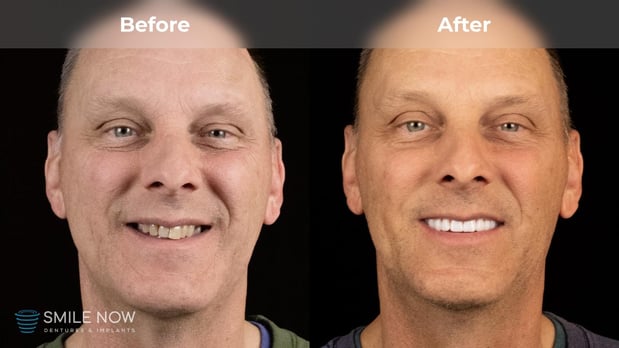 Images Smile Now Milwaukee Dentures and Implants