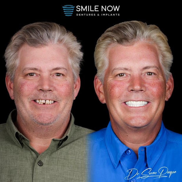 Images Smile Now Denver Dentures and Implants