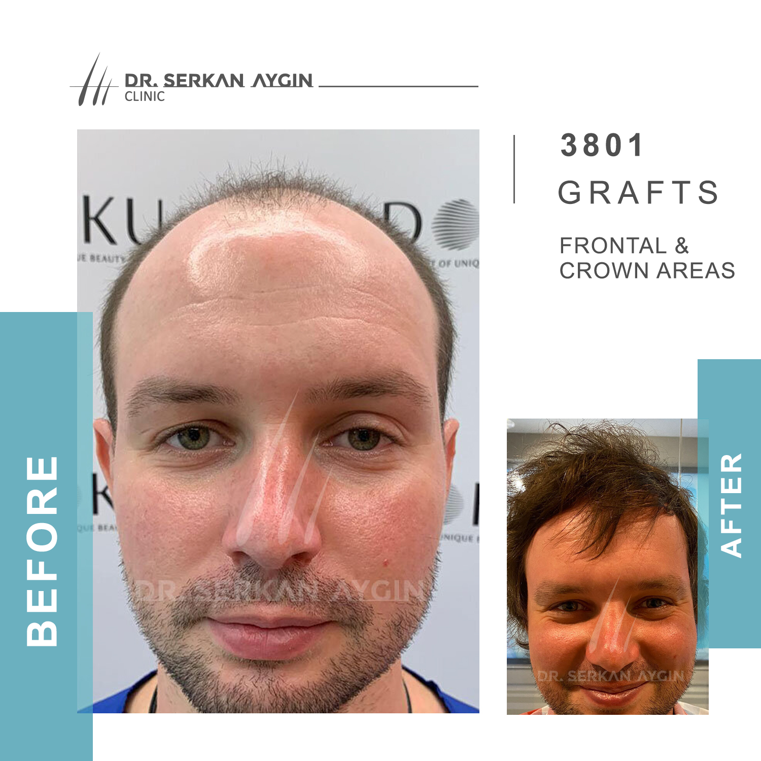 Images Hair Transplant Turkey | Dr. Serkan Aygin | London Branch Office