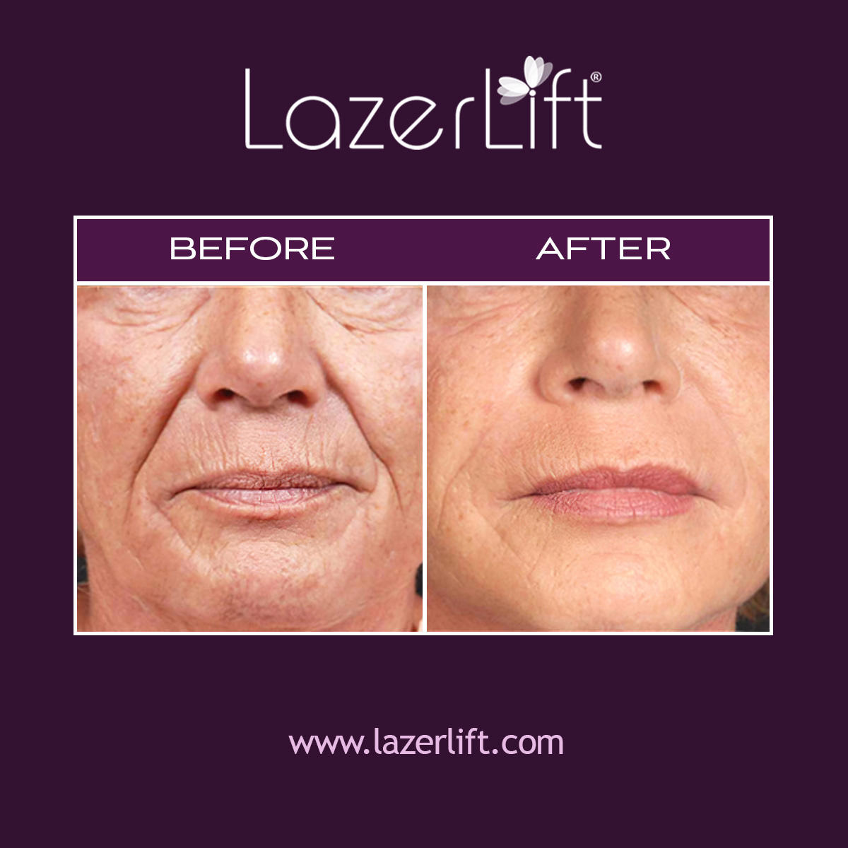 LazerLift® is the revolutionary minimally-invasive solution to combat the physical signs of facial aging. Now, patients can achieve a long-lasting lifted look without having to undergo a surgical procedure. LazerLift® uses innovative laser technology to heat the lower layers of the skin, promoting collagen production. LazerLift® is effective in tightening the lower face and neck, smoothing wrinkles, reducing sagging and jowls, and more.