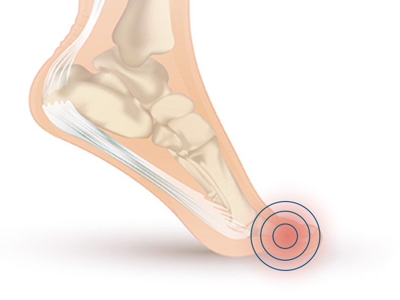 Cncrns_Cndtns-footpain-bigtoe-392x294@2x.jpg