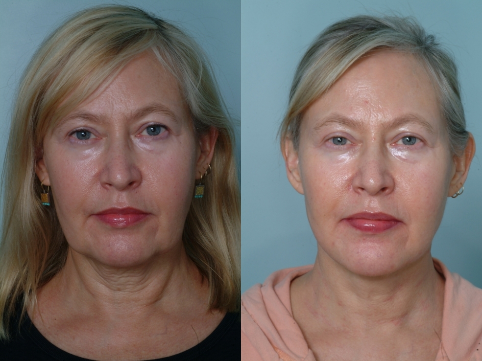 Treatment of neck laxity and jowls with laser tightening and lipodissolve