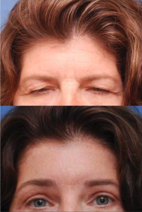 Brow Lift (& Upper Lids) Before & After at Clinic of Facial Plastic Surgery | Buffalo, NY
