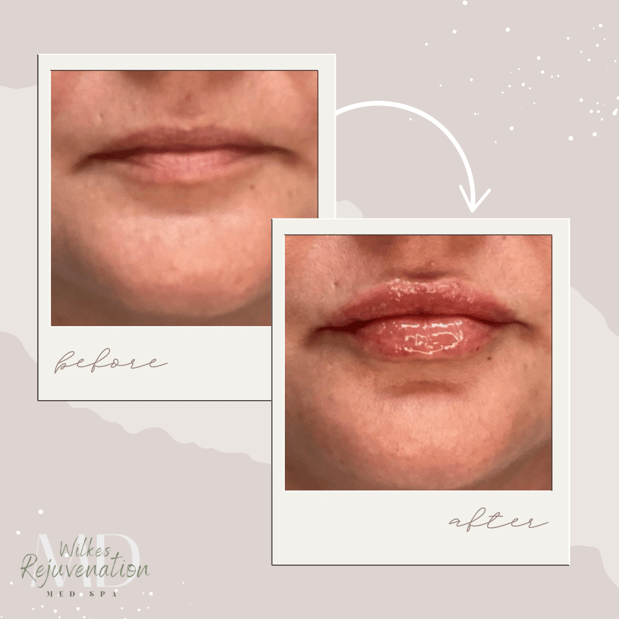 Images Wilkes Rejuvenation MD