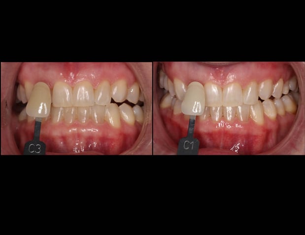 Images Light Touch Dental
