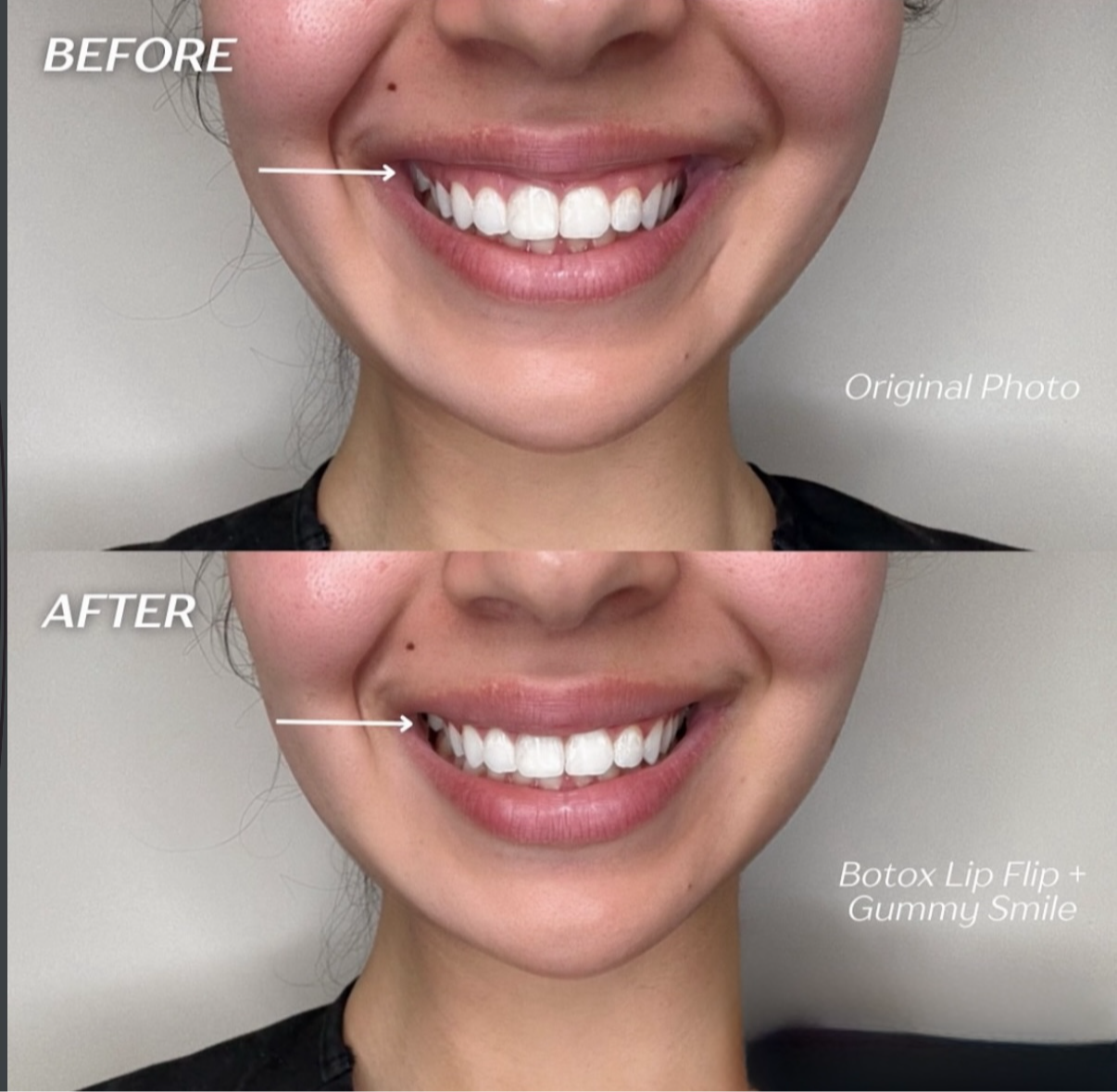 Before and after Botox lip flip treatment at KWJ Skin Clinic, a trusted aesthetic clinic in Horsham, showing natural-looking smile enhancement and subtle facial aesthetics results.