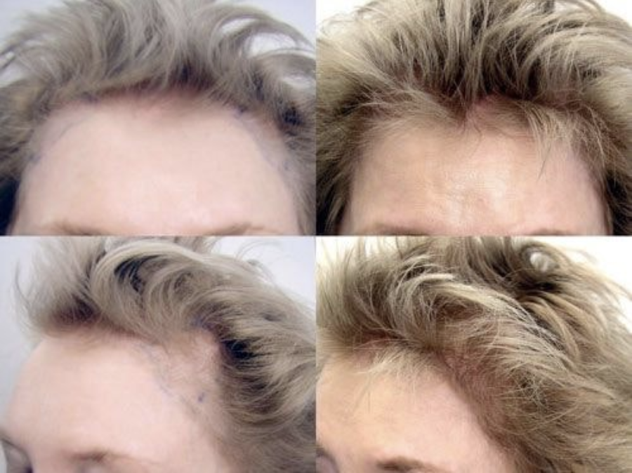 Results at The Hair Loss Doctors | New York,  NY