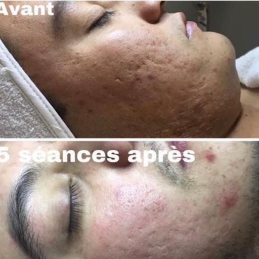 Clinique 5 Dimensions - Épilation laser, Soins de la peau, Microneedling Saint-Jérôme