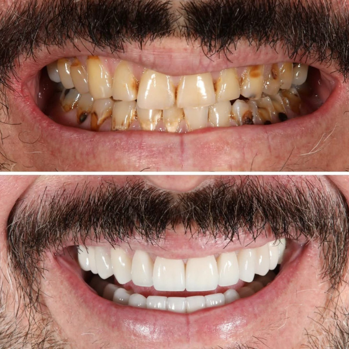 Veneers Before and After