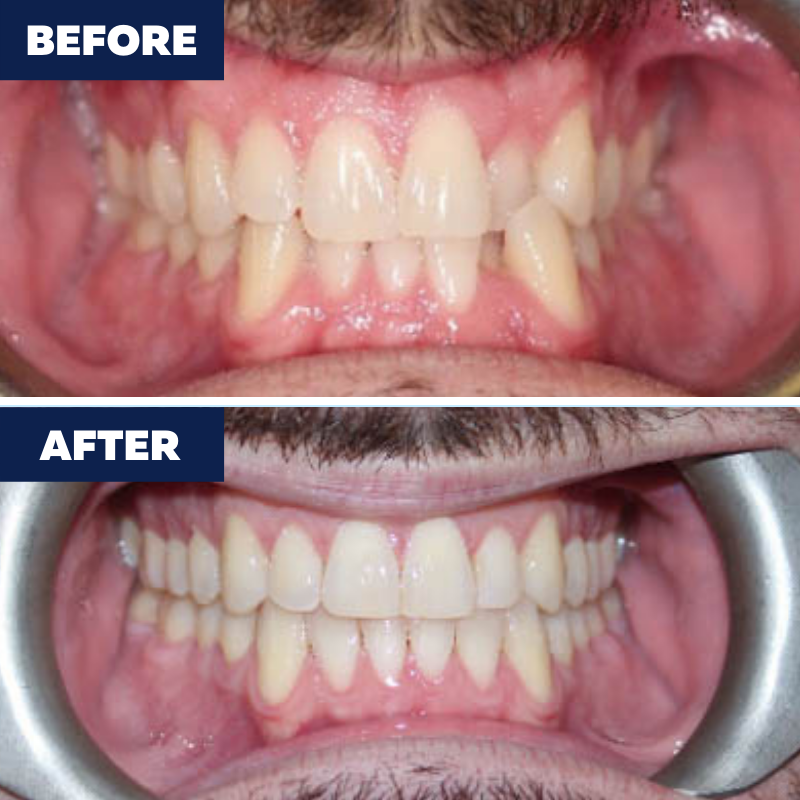 Invisalign used to treat severe crowding and crossbite. Call us to schedule a consultation! (424) 31 Orthodontics of Torrance Torrance (424)201-0712
