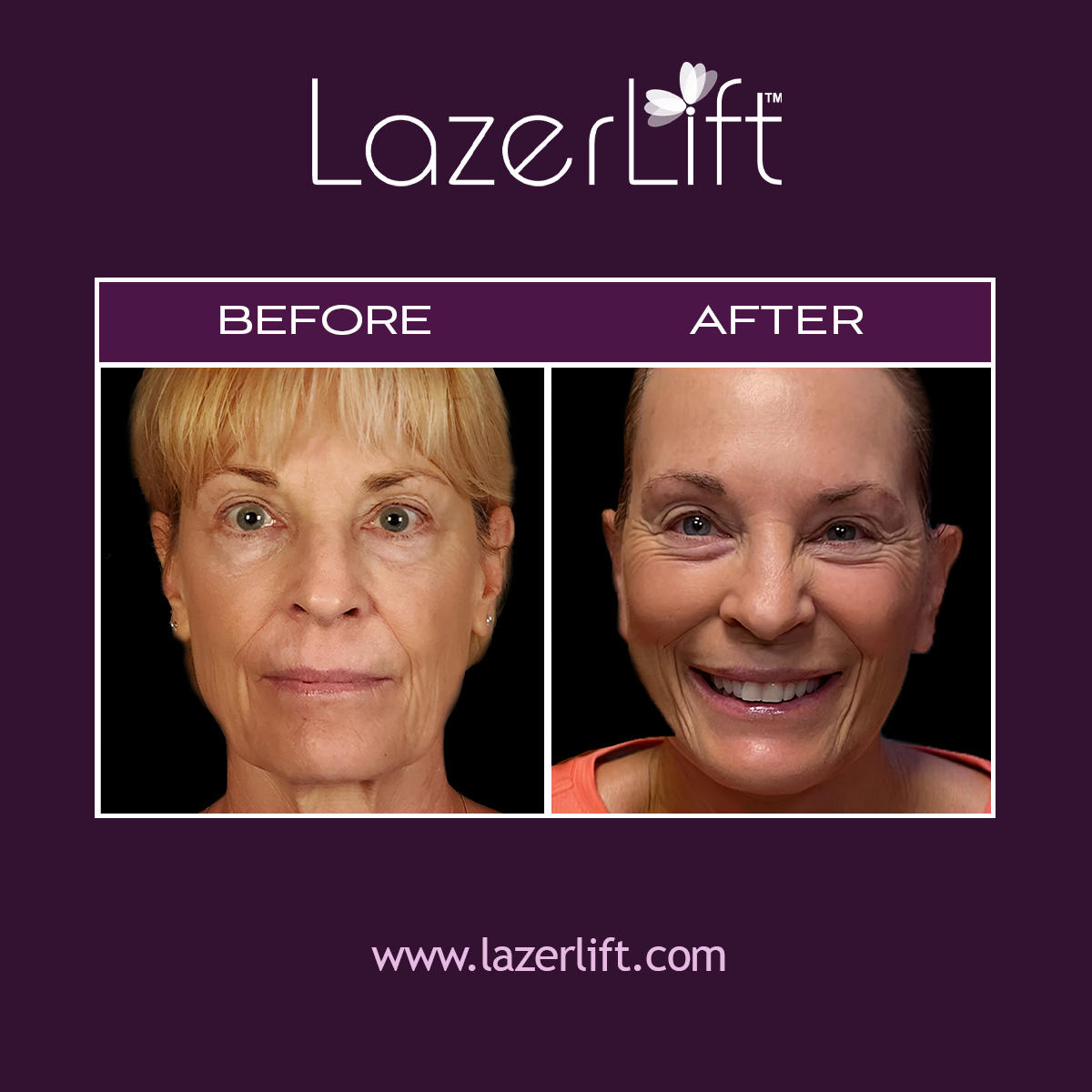 LazerLift® is a minimally-invasive solution to facial aging. LazerLift® uses revolutionary laser technology to tighten and lift the skin, increase collagen production and create long-lasting results. The procedure takes as little as 30 minutes to perform in-office. Most patients are able to drive themselves home and continue normal activities immediately after undergoing the procedure.