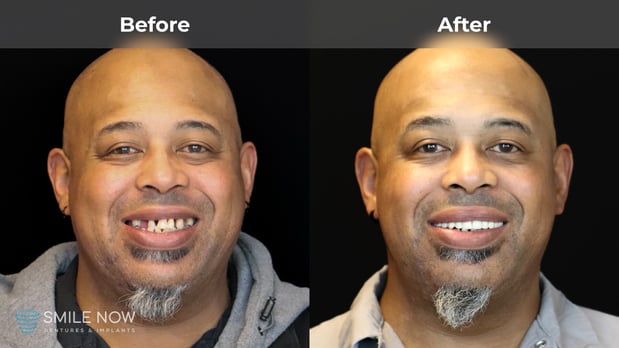 Images Smile Now Tacoma Dentures and Implants