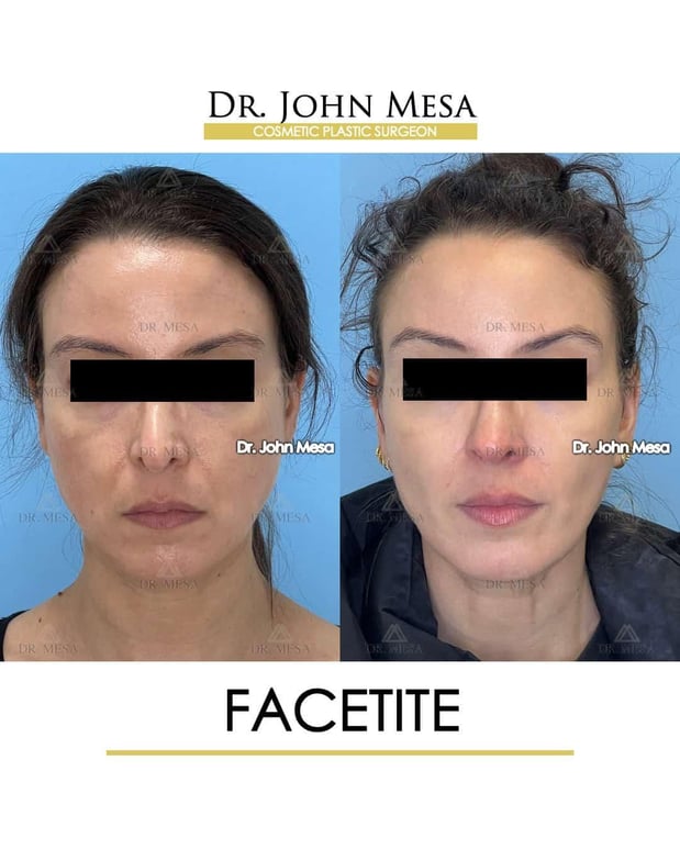 Images Dr. John Mesa, MD: Plastic Surgeon NYC, Buccal Fat Removal, Chin Liposuction, Facelift, Facial Masculinization, Chin Implant
