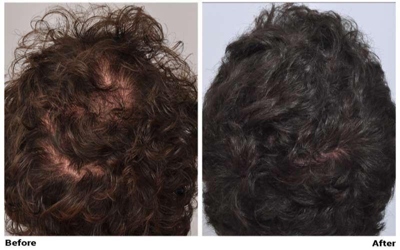 Images ForHair NYC Restoration Clinic - Dr. John Cole
