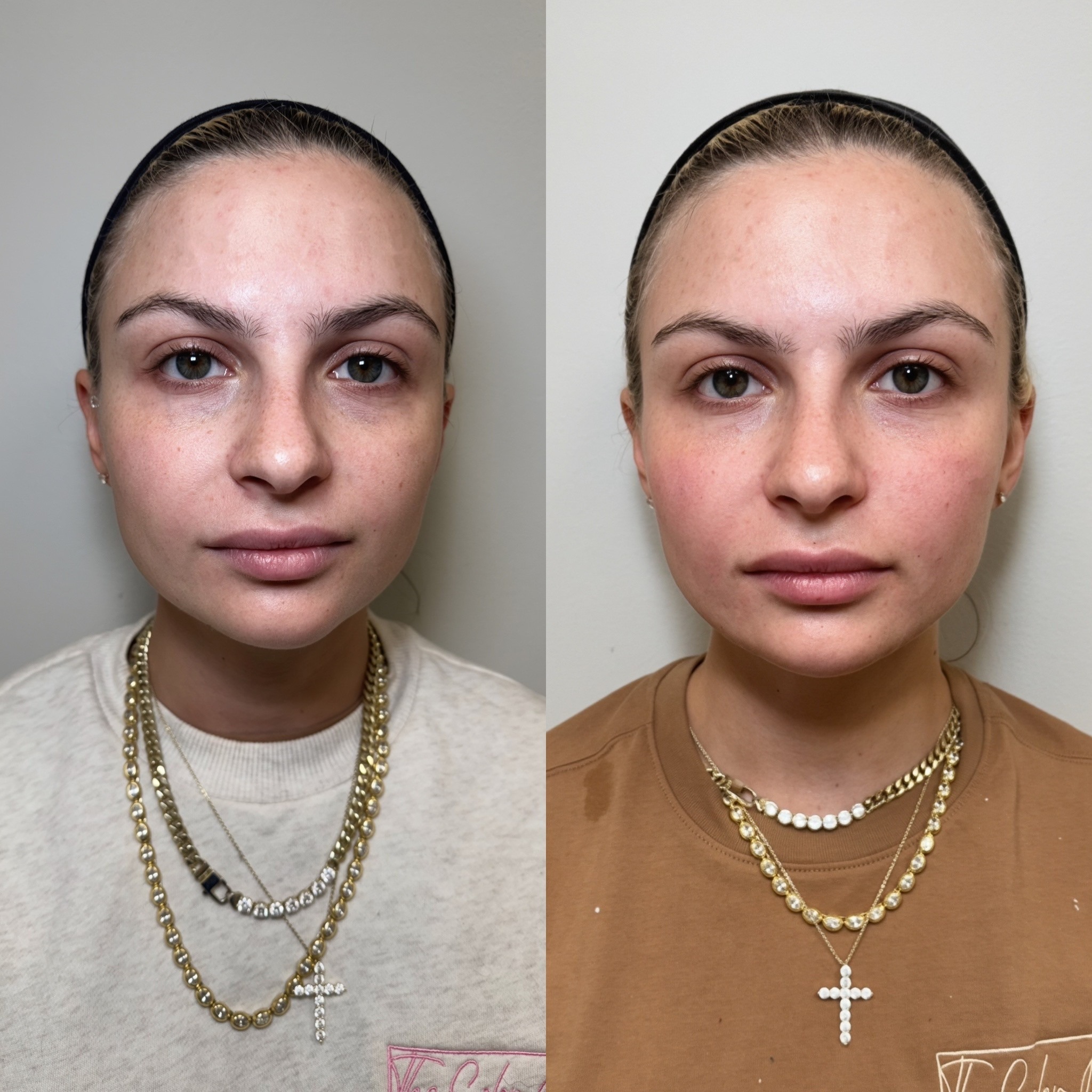 Before and after results, Care Esthetics Delaware