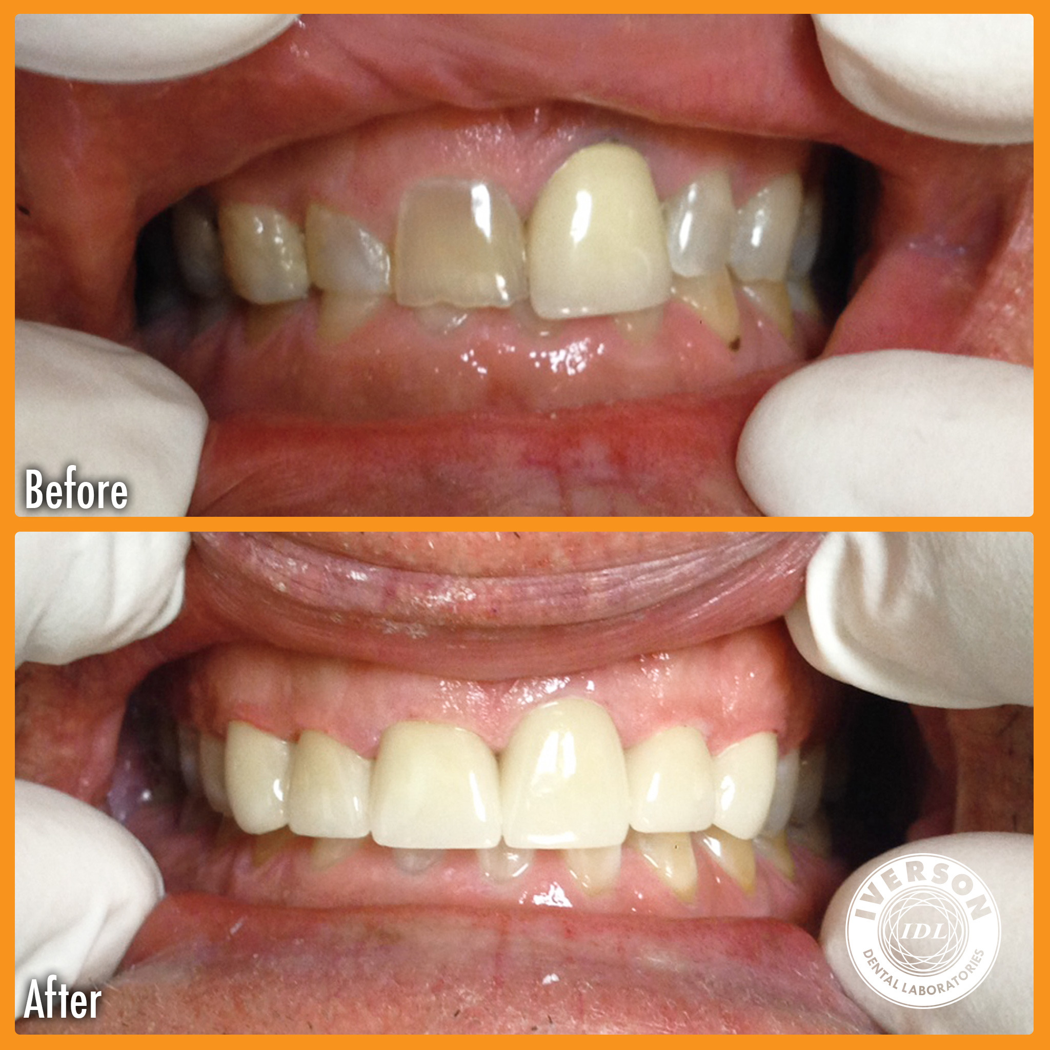A close-up of a patient with chipped and discolored teeth, now radiating confidence with perfectly restored, white, and smooth teeth post-restoration.