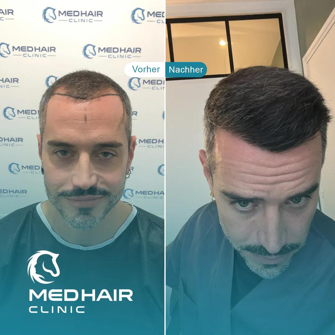 MedHair Clinic | Haartransplantationen in der Türkei Istanbul, Höninger Weg 176 in Rodenkirchen