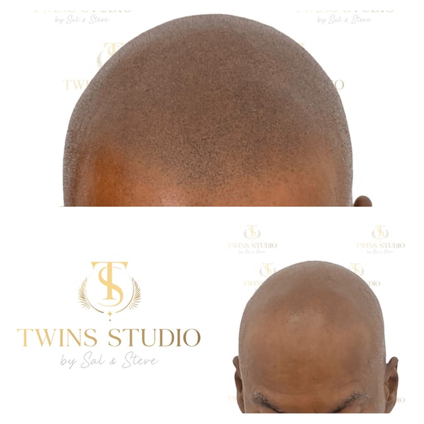 Images Twins Studio (Scalp Micropigmentation - SMP)