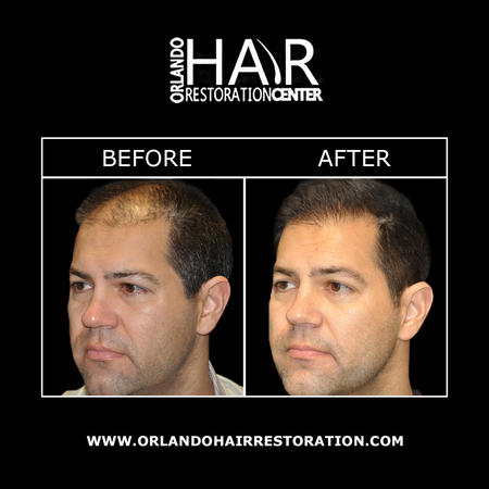 Advantages in hair restoration have improved hair restoration results with procedures and techniques that require little to no downtime. Dr. Bassin is considered an expert in the field of hair transplantation and can help you regrow a fuller head of hair. Contact Orlando Hair Restoration Center today!