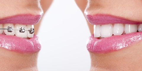 Dentistry vs. Orthodontics: What’s the Real Story?