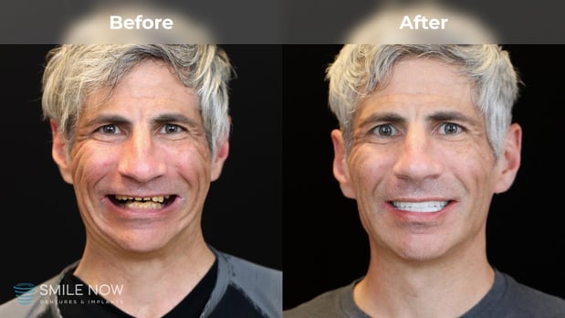 Images Smile Now Milwaukee Dentures and Implants