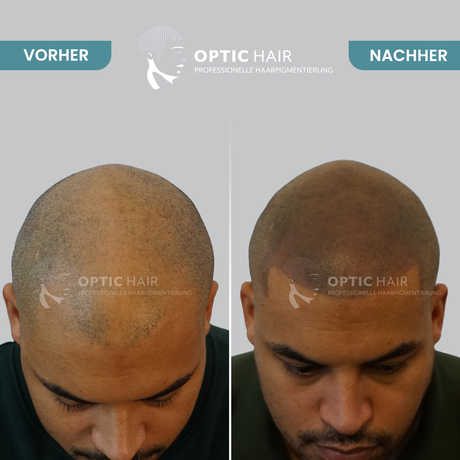 Bild 4 Haarpigmentierung Berlin | OpticHair in Berlin