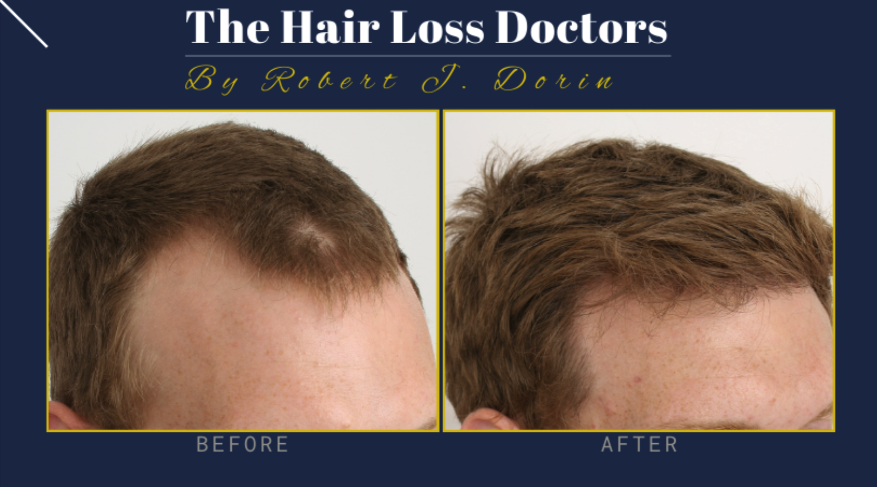 Best 30 Hair Replacement in Long Island NY with Reviews