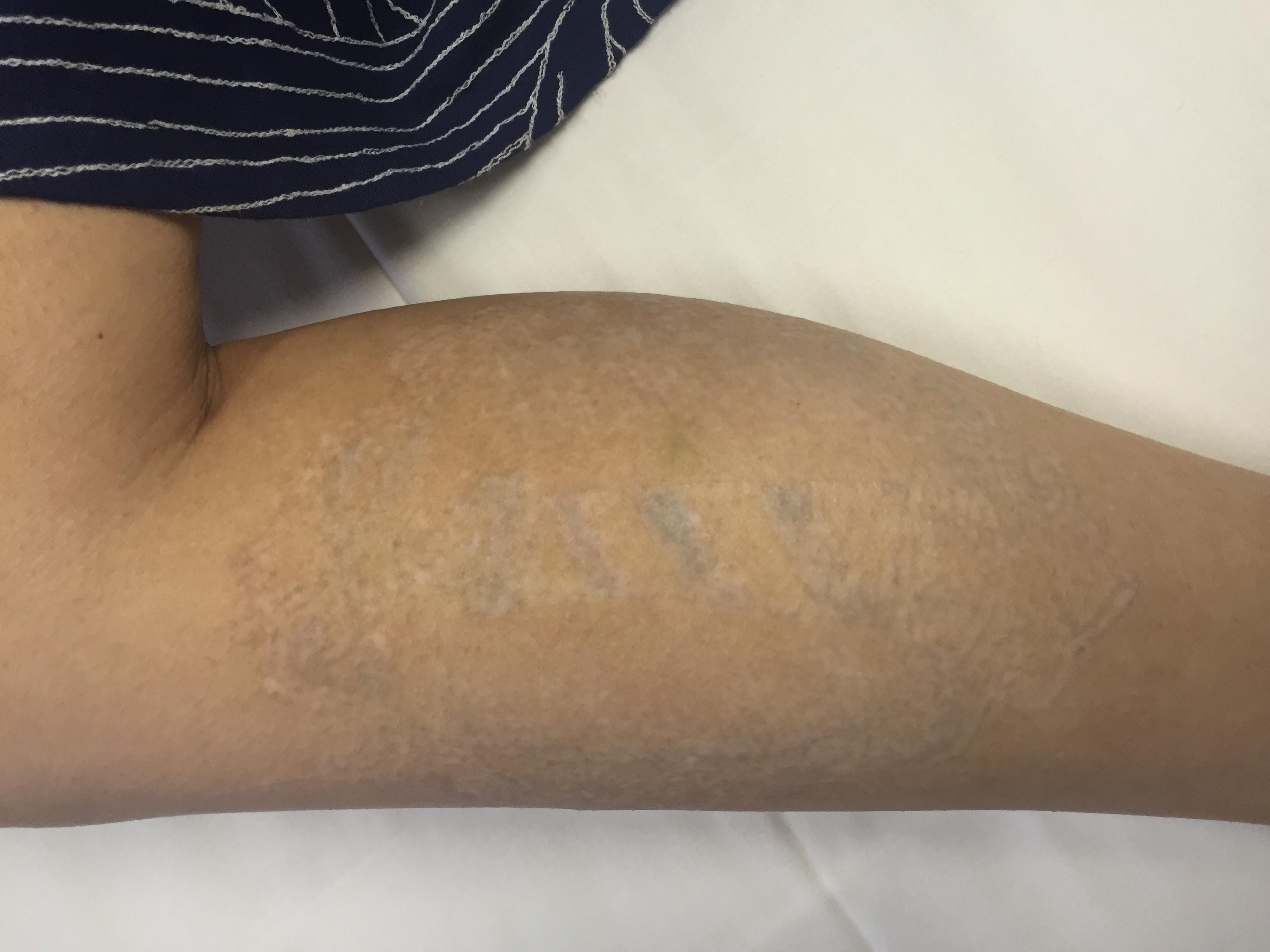medermis laser tattoo removal in san antonio tx 78258 medermis laser tattoo removal in san antonio tx 78258