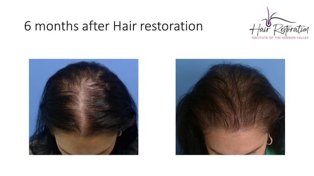 Images Hair Restoration Institute of the Hudson Valley