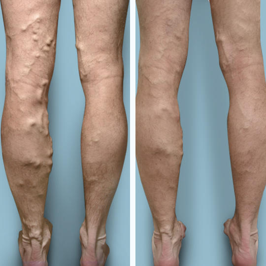 Before and after: varicose vein removal results. We offer a variety of varicose vein treatments, done in under 15 minutes!