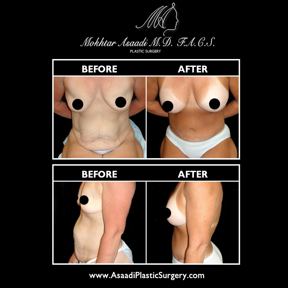Dr. Asaadi performs mommy makeover in New Jersey. A mommy makeover can remove excess abdominal fat while tightening the underlying muscles and improve the shape and size of the breasts. During a mommy makeover, breast augmentation, liposuction, abdominoplasty, and more are combined to sculpt the midsection, improve body contours, and enhance the breasts.