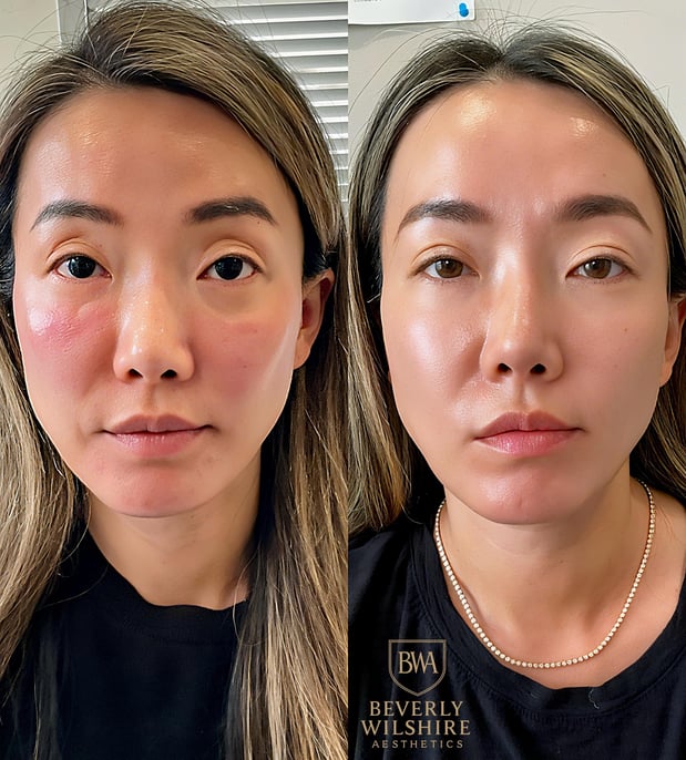 Images Beverly Wilshire Aesthetics Beverly Hills Medical Spa for Botox, Morpheus8, IPL, Lip Fillers