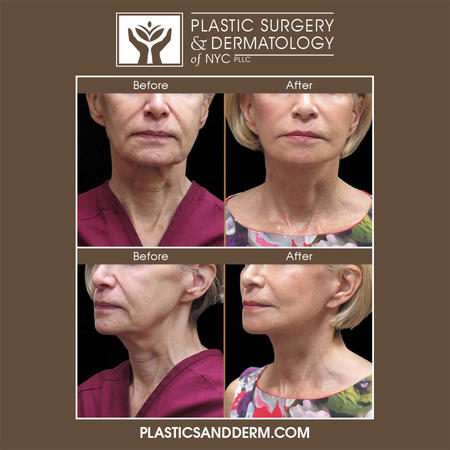 Facelift surgery can reverse the signs of facial aging, such as deep wrinkles, jowls, and sagging skin. Facelift surgery lifts the underlying soft tissue to a more natural and youthful position and tightens the skin. Those seeking long-lasting facial rejuvenation are often candidates for facelift surgery. Minimally invasive solutions, such as FaceTite and LazerLift, are also available to achieve natural-looking results with technology that includes radio frequency and lasers.