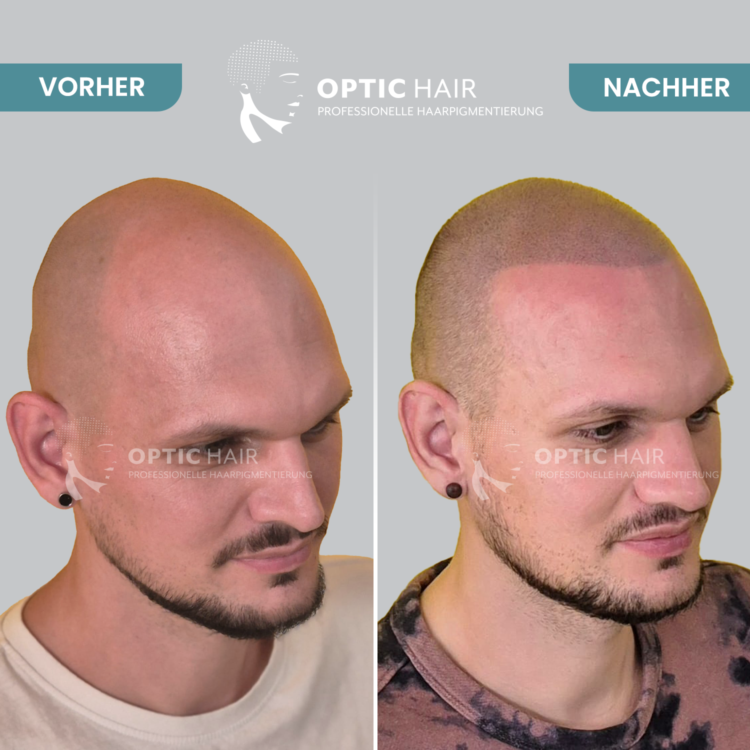 Kundenbild groß 6 Haarpigmentierung Köln | OpticHair