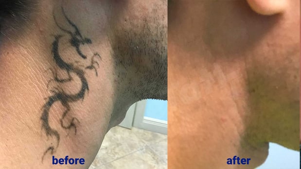 Images TakeTatt Tattoo Removal