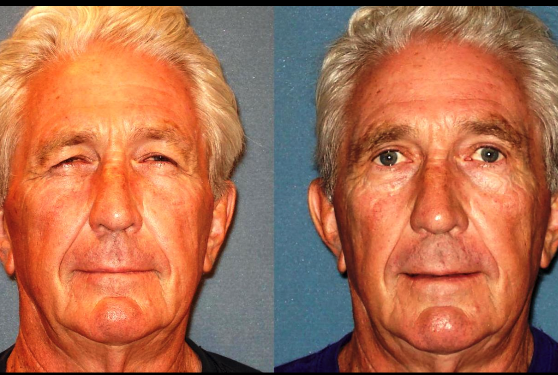 Before & After Results of Arizona Eye Institute & Cosmetic Laser Center | Sin City, AZ