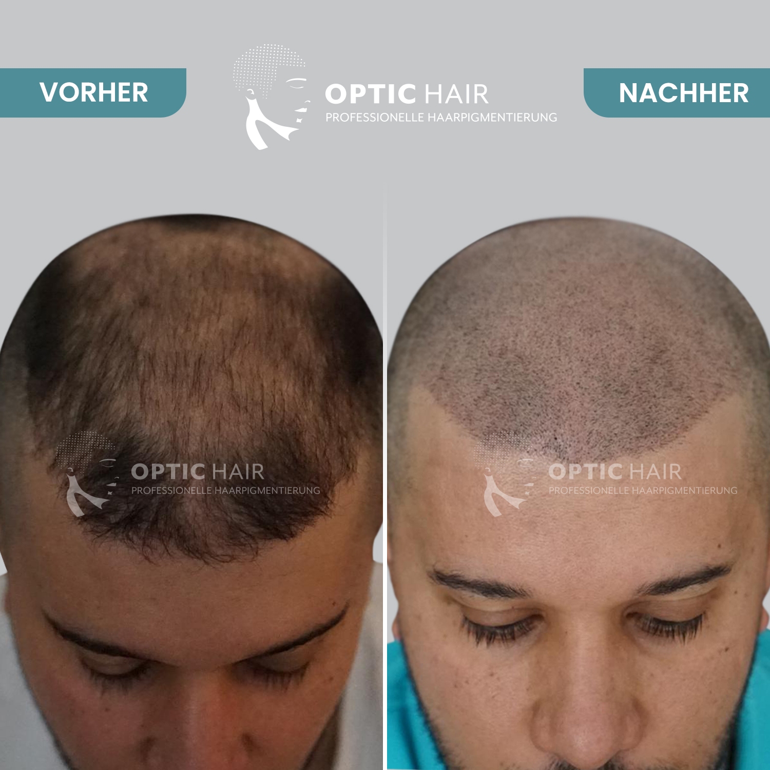 Kundenbild groß 19 Haarpigmentierung Köln | OpticHair