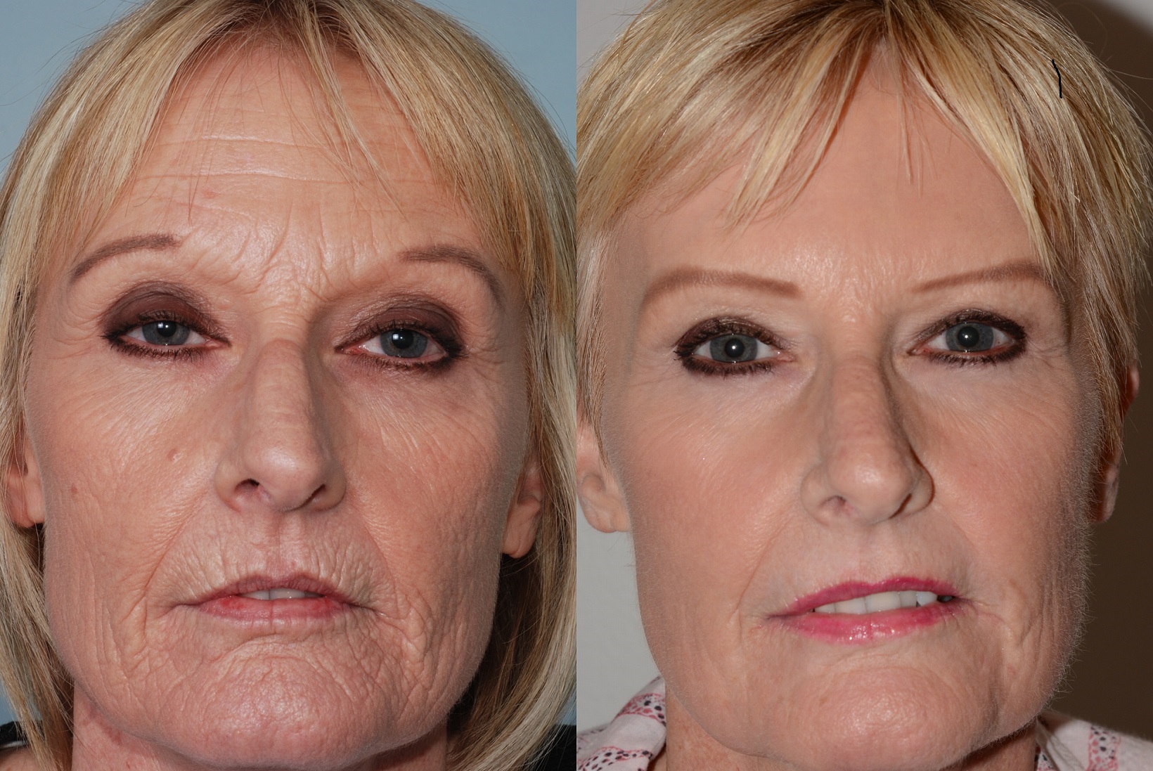 Before (left)_ and after (right) 6 years and 6 months following fully and fractionally ablative laser resurfacing laser blepharoplasty, Nd-YAG laser tightening, Dysport and Filler.