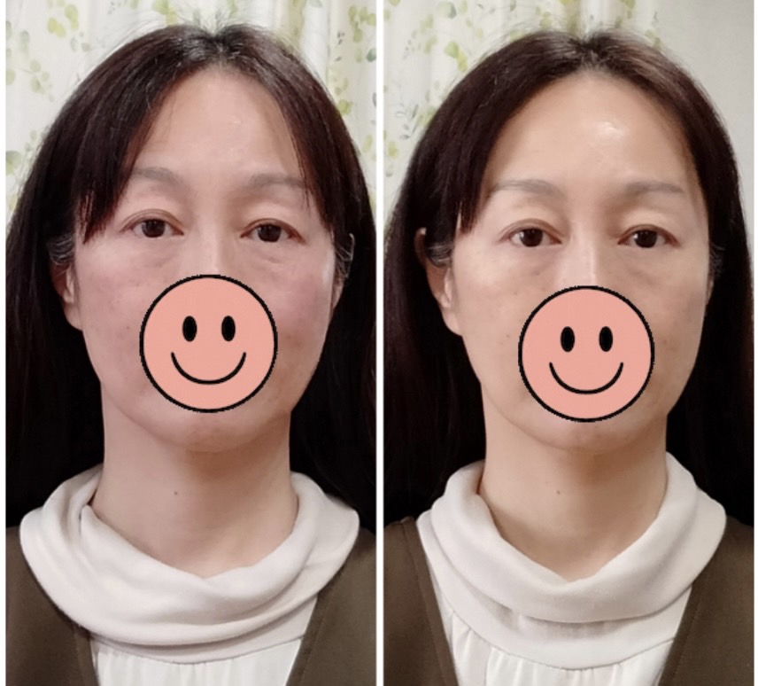 Images 目元・口元のたるみ&眉間シワ改善専門サロン