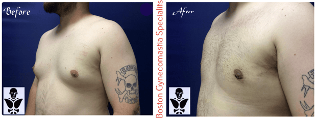 Images Boston Gynecomastia Specialists