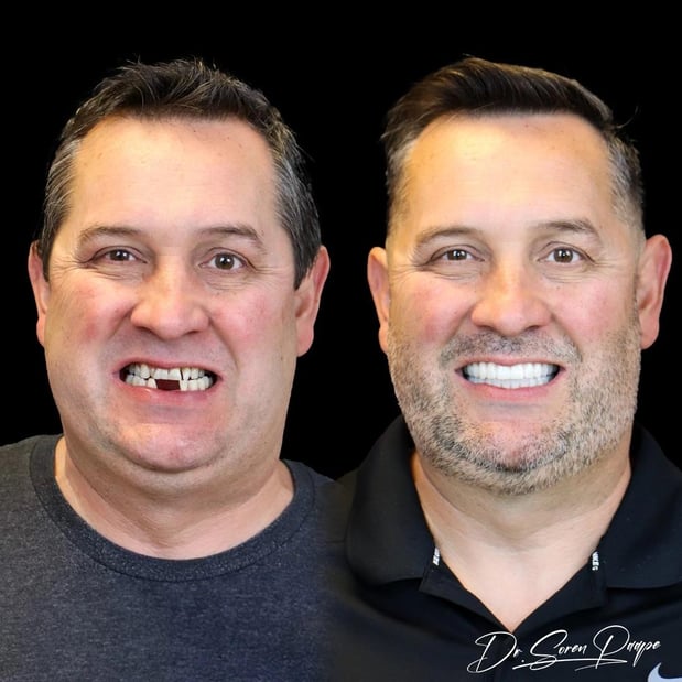 Images Smile Now Denver Dentures and Implants