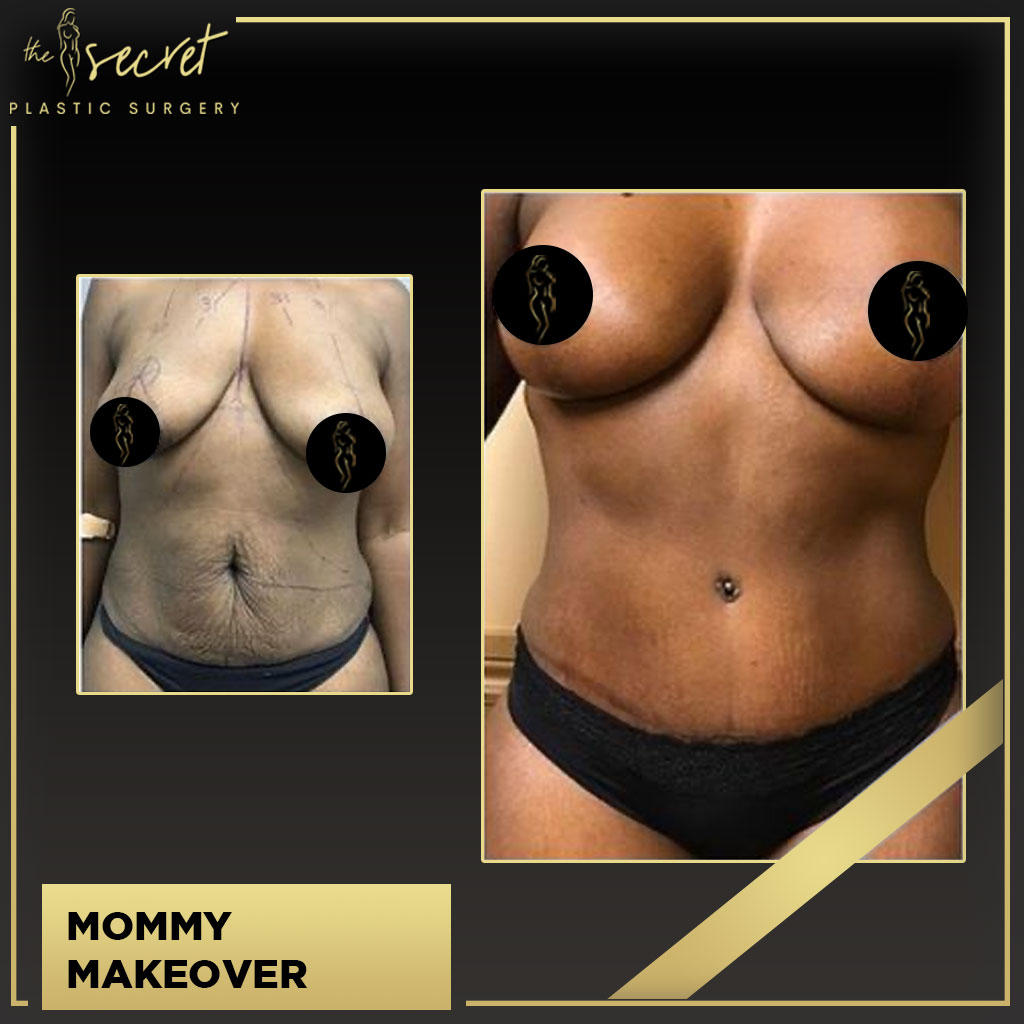 Mommy Makeover - The Secret Plastic Surgery