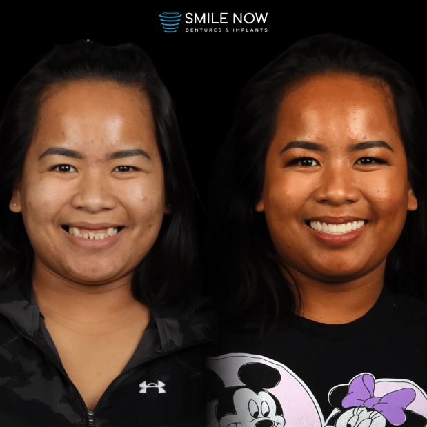 Images Smile Now Milwaukee Dentures and Implants