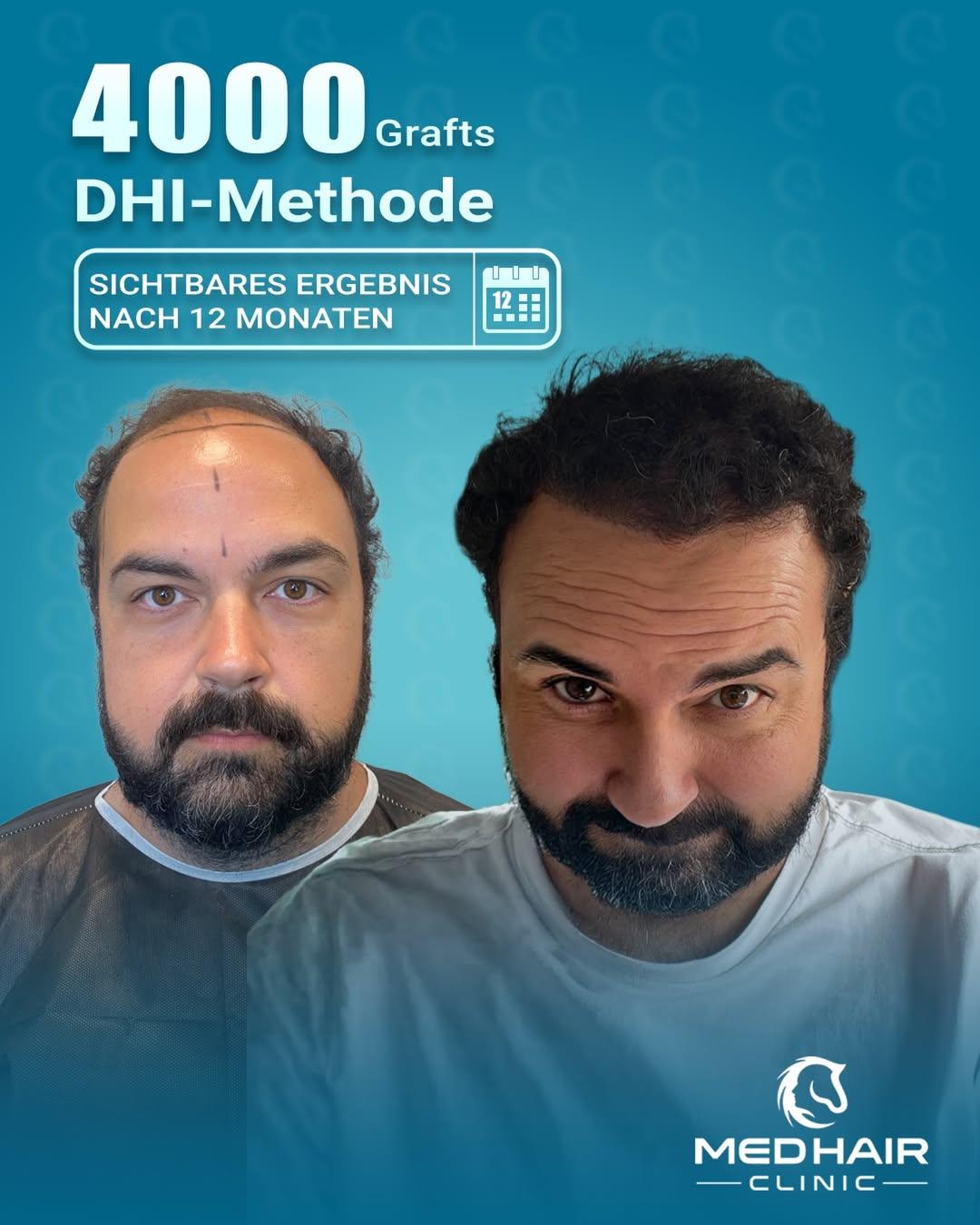 MedHair Clinic | Haartransplantationen in der Türkei Istanbul, Höninger Weg 176 in Rodenkirchen